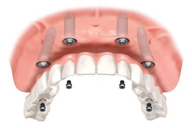 four-dental-implants